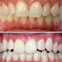 Cosmetic Teeth Whitening - Vanitylaser