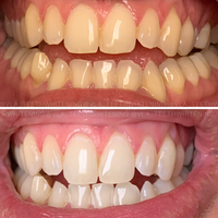 Cosmetic Teeth Whitening - Vanitylaser