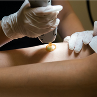 Full Body Hottie Laser Hair Removal Package - Vanitylaser