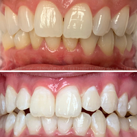 Cosmetic Teeth Whitening