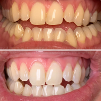 Cosmetic Teeth Whitening