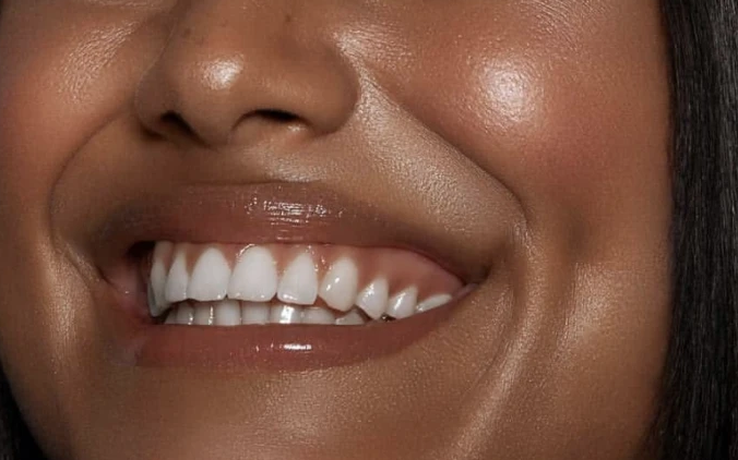 Cosmetic Teeth Whitening